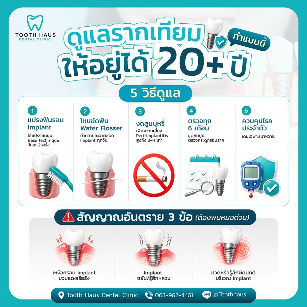 รากฟันเทียมอยู่ได้นานไหม