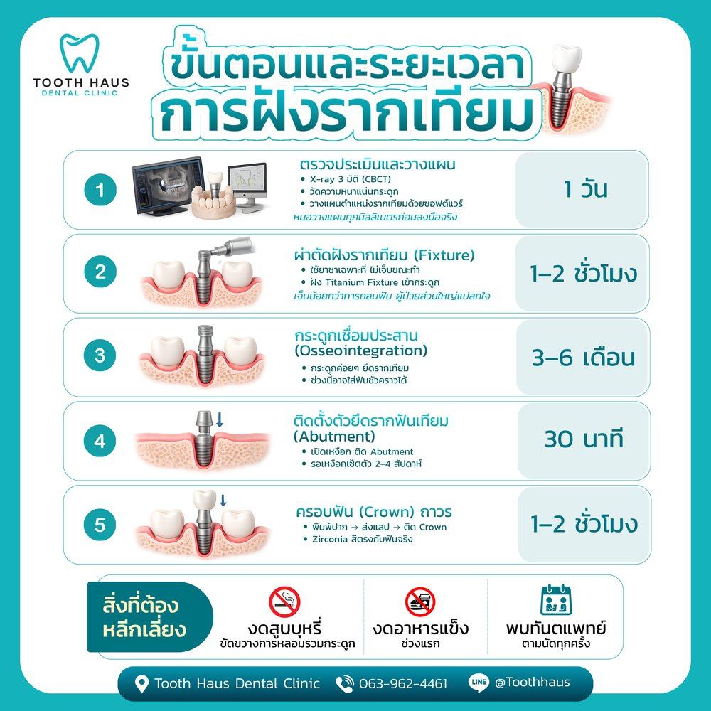 ขั้นตอนและระยะเวลาการฝังรากเทียม 5 ขั้นตอน ตั้งแต่ X-ray 3D จนถึงครอบฟันถาวร — Tooth Haus Dental Clinic