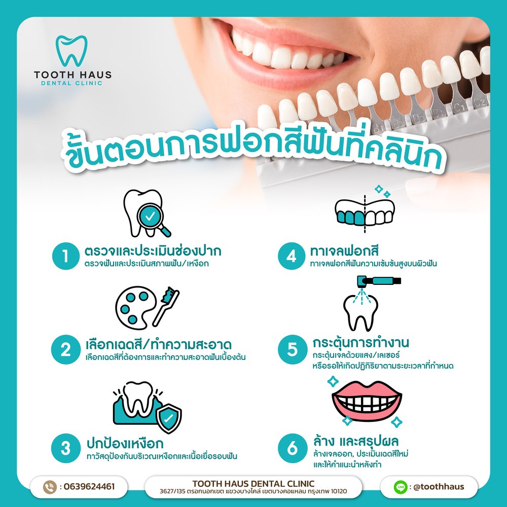 Teeth whitening options